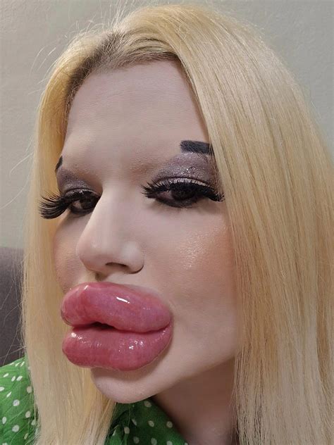 Timmantha Lip Expansion .